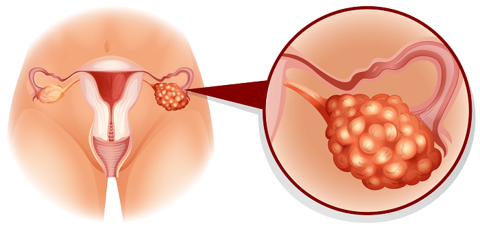 قرص برای تنبلی تخمدان